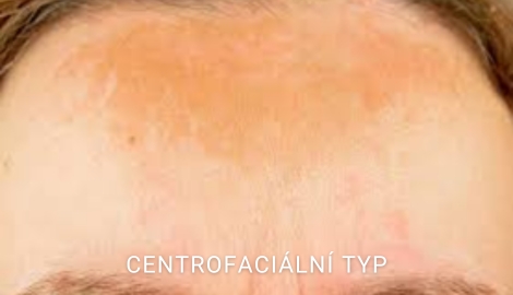 Centrofaciální typ melasma