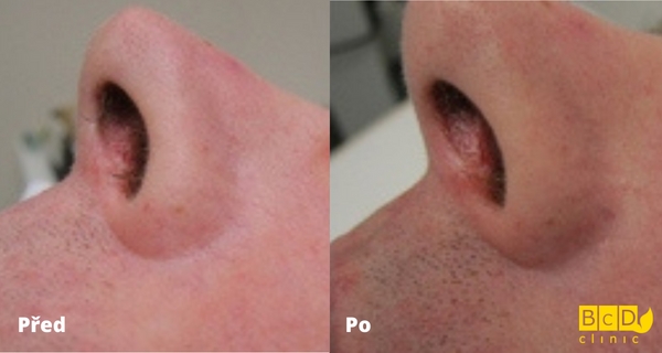 Laserová depilace nosních dírek - před a po zákroku
