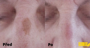 Laserové odstranění pigmentací - před a po