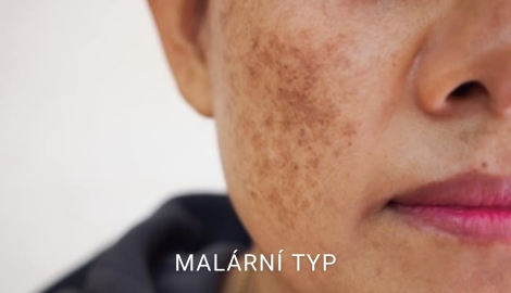 Malární typ melasma