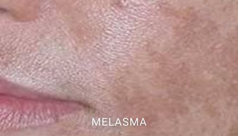 Melasma