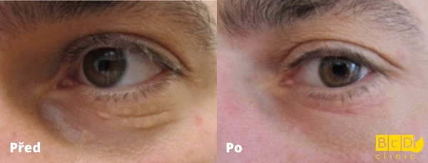 Odstranění xanthelazmat u očí frakčním CO2 laserem - před a po