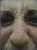 Nos - odstranění vrásek botulotoxinem  - před zákrokem