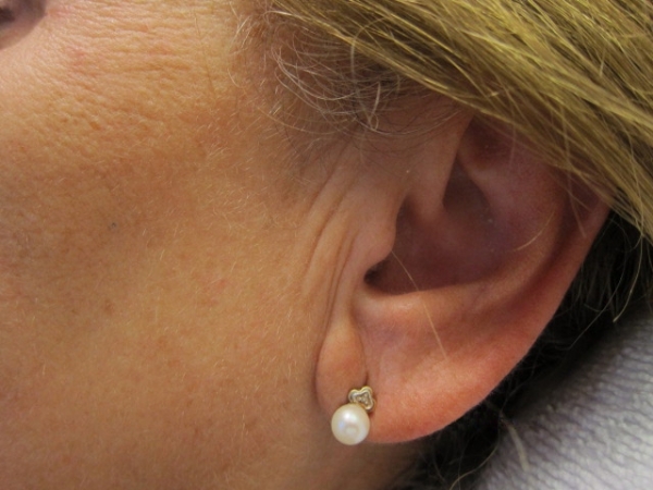 Ucho - výplň vrásek kyselinou hyaluronovou - před zákrokem