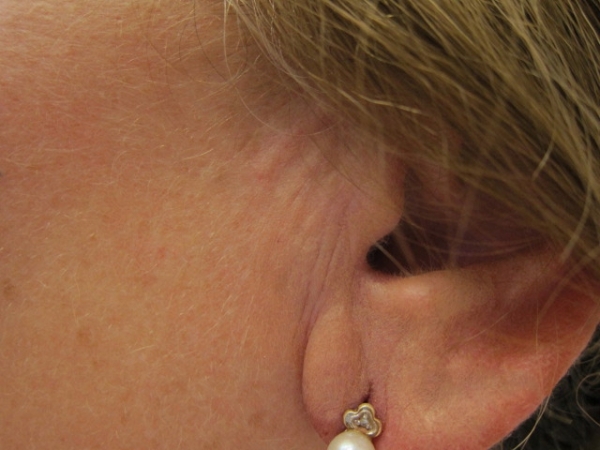 Ucho - výplň vrásek kyselinou hyaluronovou - po zákroku