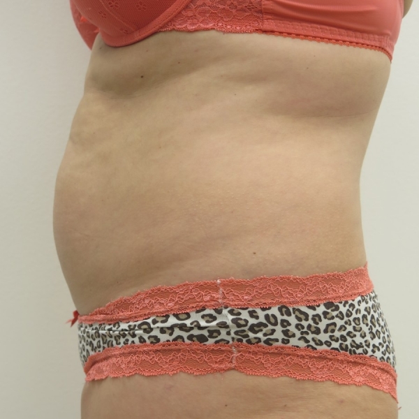 Laserová liposukce břicha - před zákrokem