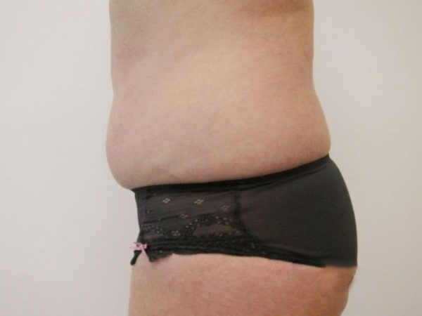 Laserová liposukce břicha - před zákrokem