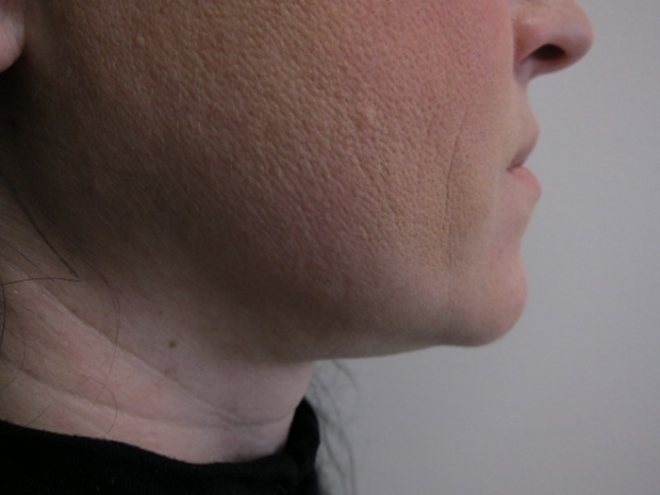 Laserové odstranění dvojité brady - před zákrokem