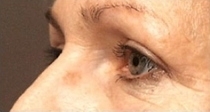 Plastická operace očních víček - po zákroku