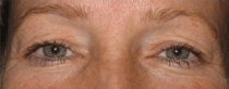 Plastická operace očních víček - před zákrokem