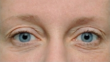 Plastická operace očních víček - před zákrokem