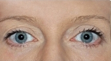 Plastická operace očních víček - po zákroku