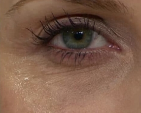 Mezoterapie PŘED zákrokem a PO zákroku