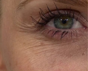 Mezoterapie PŘED zákrokem a PO zákroku