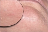 Depilace laserem - brada před a po zákroku