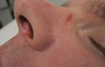 Depilace laserem – chloupky v nose před a po zákroku