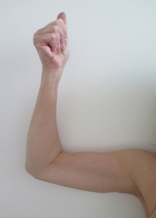 EM Slim™NEO bodycontouring - paže - PŘED a PO zákroku