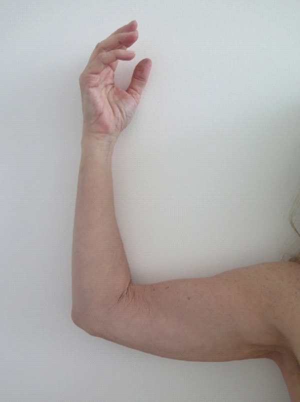 EM Slim™NEO bodycontouring - paže - PŘED a PO zákroku