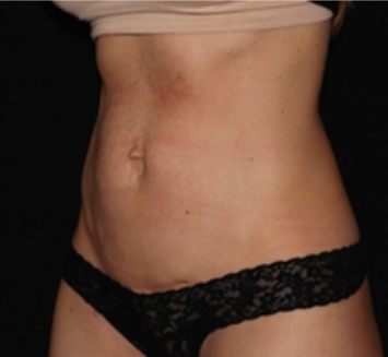 EM Slim™NEO bodycontouring PŘED a PO zákroku