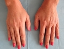 Hřbety rukou - Výplň kyselinou hyaluronovou před a po zákroku