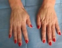 Hřbety rukou - Výplň kyselinou hyaluronovou před a po zákroku