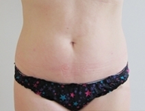 Laserová liposukce břicha - před a po zákroku