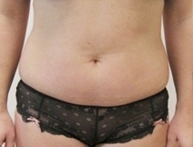 Laserová liposukce břicha - před a po zákroku