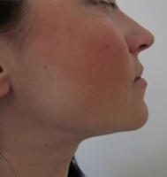 LIPOSUCTION OF THE DOUBLE CHIN	