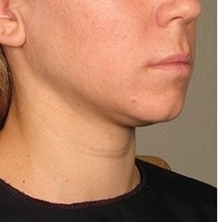 Lipolýza tuku - Aqualyx (před a po)