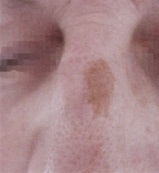 Odstranění pigmentace laserem - nos před a po zákroku