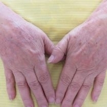 Odstranění pigmentací laserem - hřbety rukou před a po zákroku