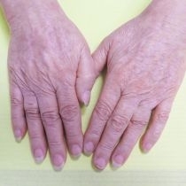 Odstranění pigmentací laserem - hřbety rukou před a po zákroku