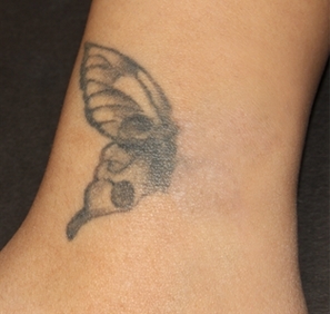 Odstranění tetování před a po zákroku