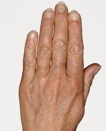 Omlazení hřbetů rukou - Vital injektor před a po zákroku