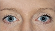 Plastická operace očních víček před a po zákroku