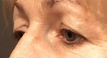 Plastická operace očních víček před a po zákroku