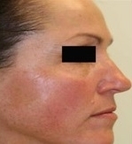 Plazmaterapie - plazmalifting obličeje před a po zákroku