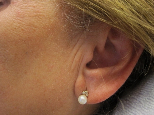 Ucho - výplň vrásek kyselinou hyaluronovou - před a po zákroku