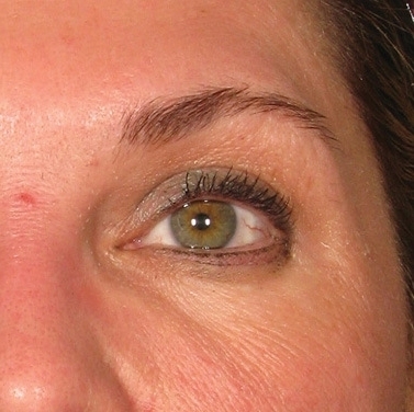 Ultherapie kolem očí před a po zákroku