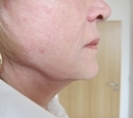 Ultherapie spodní část obličeje před a po zákroku