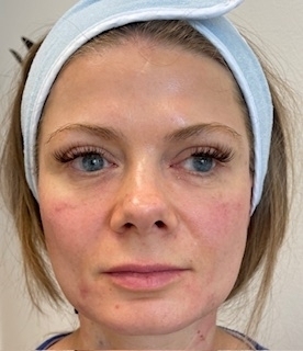 Biostimulační výplň Aesthefill - PO