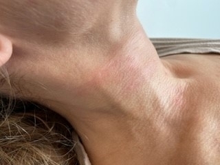 Calcium hydroxyapatit - PO zákroku