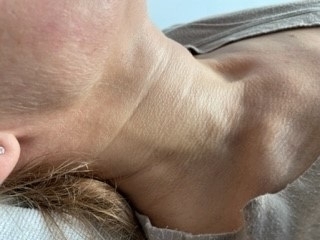 Calcium hydroxyapatit - PŘED zákrokem