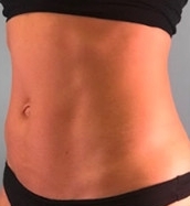 EM Slim™NEO - břicho - PO zákroku EM Slim™NEO - břicho - PO zákroku