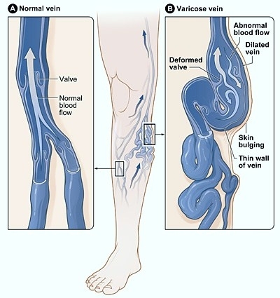 Varicose veins and their occurrence
