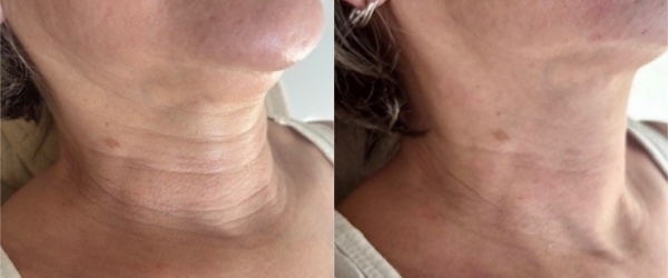 Lanluma PŘED zákrokem a PO zákroku