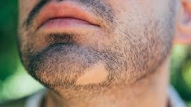Ložiskové vypadávání vousů- alopecia areata