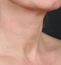 Mezoterapie krku PO zákroku Mezoterapie krku PO zákroku