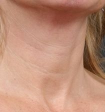 Mezoterapie krku PŘED zákrokem Mezoterapie krku PŘED zákrokem