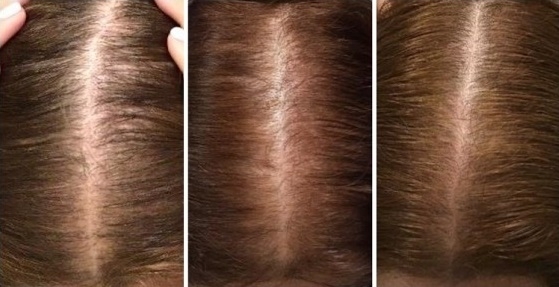 Postupné zahuštění vlasů po léčbě po půl roce